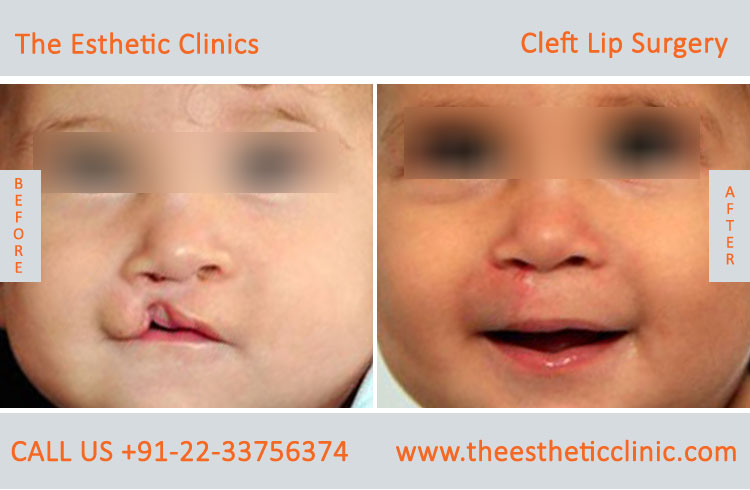 cleft lip surgery, Unilateral Cleft Lip Repair Treatment before after photos in mumbai india (1)